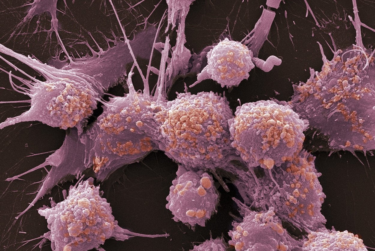Что такое онкология. Раковые клетки метастазы. Пролиферация раковых клеток. Метастазы злокачественных опухолей. Метастазирование карцином.